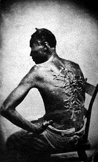 A slave's scars after being whipped